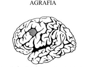 AGRAFIA | Mind Map