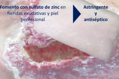 Fomentos astringentes y antisépticos en heridas y piel perilesional