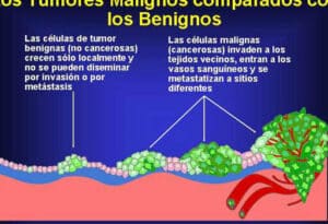 Diferencia entre tumor maligno y benigno - Diagnóstico Rojas