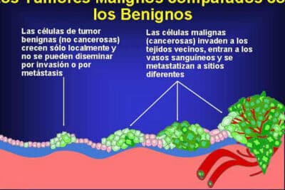 Diferencia entre tumor maligno y benigno - Diagnóstico Rojas